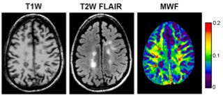 Example of conventional MRI demonstrating MS lesions and myelin water fraction (MWF) map. This is showing lower myelin in MS lesions.