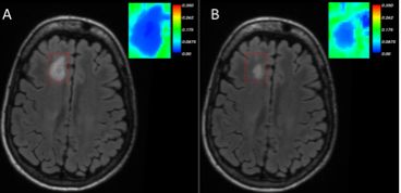 Example of a new lesion in panel A and MWF of lesion (inset). Improvement of lesion and MWF is shown in panel B.