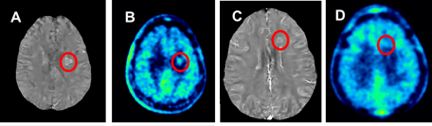 Example of rim of iron in lesions on QSM and desmontrating higher inflammation on PET scans.